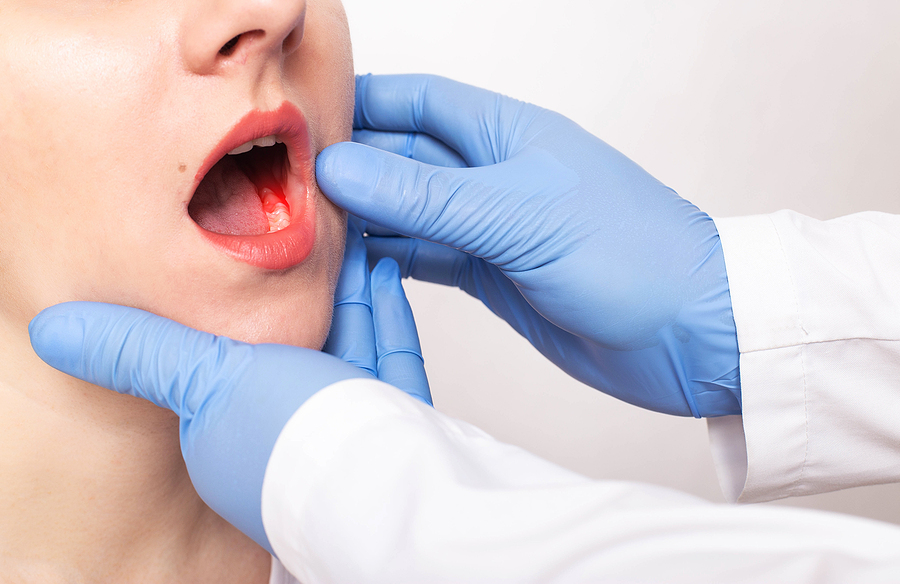 Surgical Treatment Might Be Needed for an Abscess