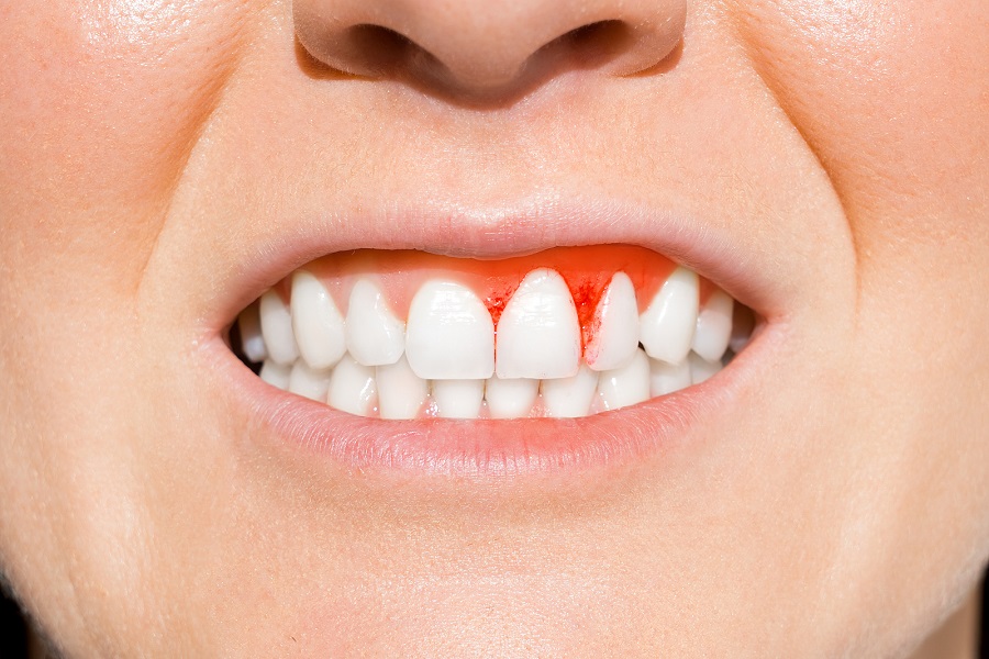 Treatments Available for Bleeding Gums