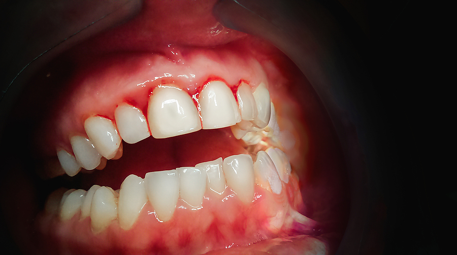 Comprehensive Guide to Bleeding Gum Treatment in Midland, TX: Causes, Prevention, and Care
