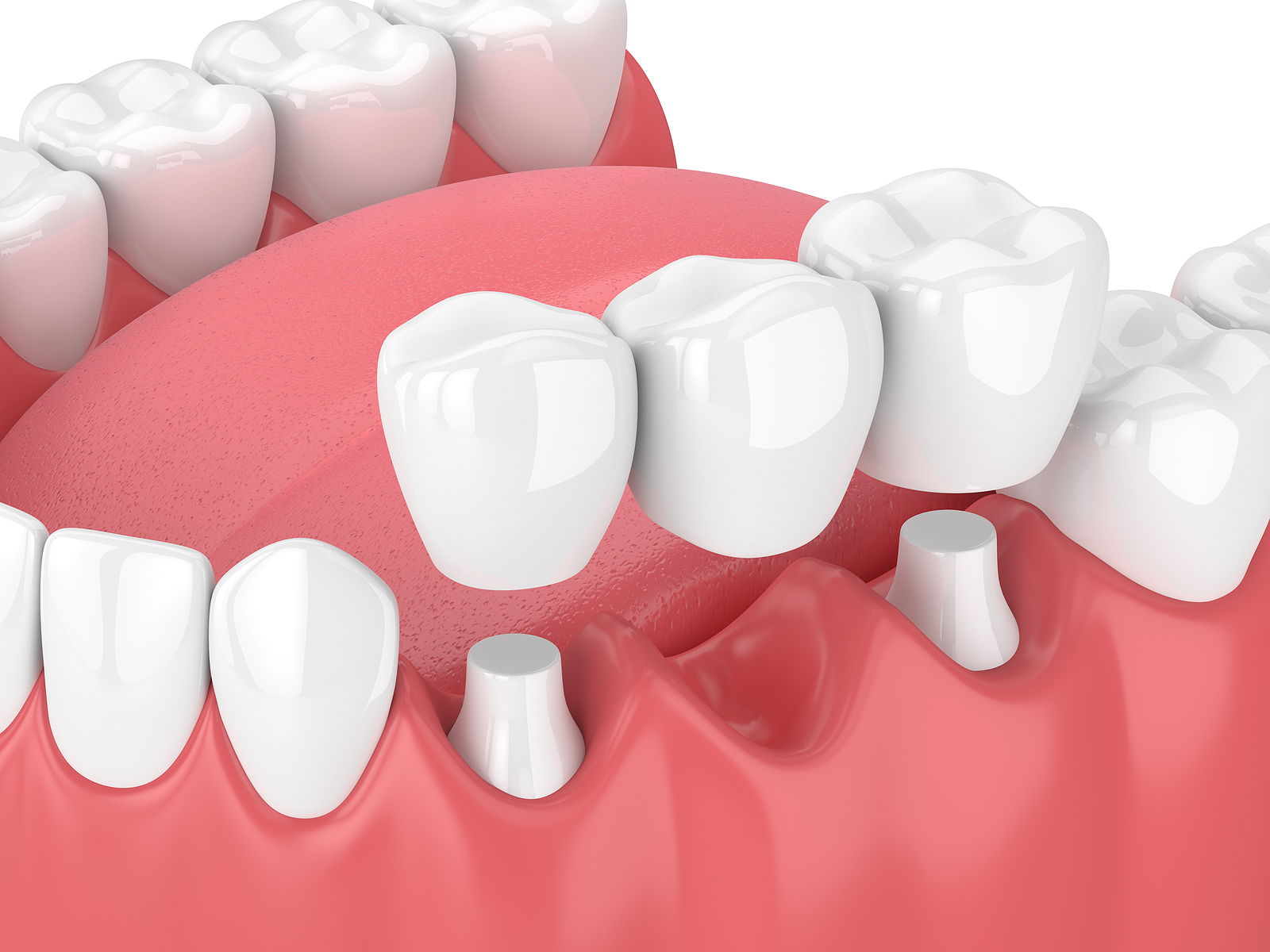 Dental Bridges in Midland, TX: A Comprehensive Guide to Restoring Your Smile