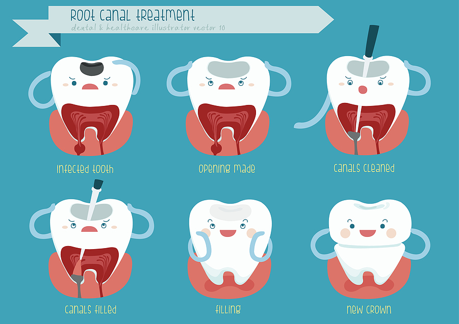 Preserving Your Smile: Understanding Root Canal Therapy in Midland, TX