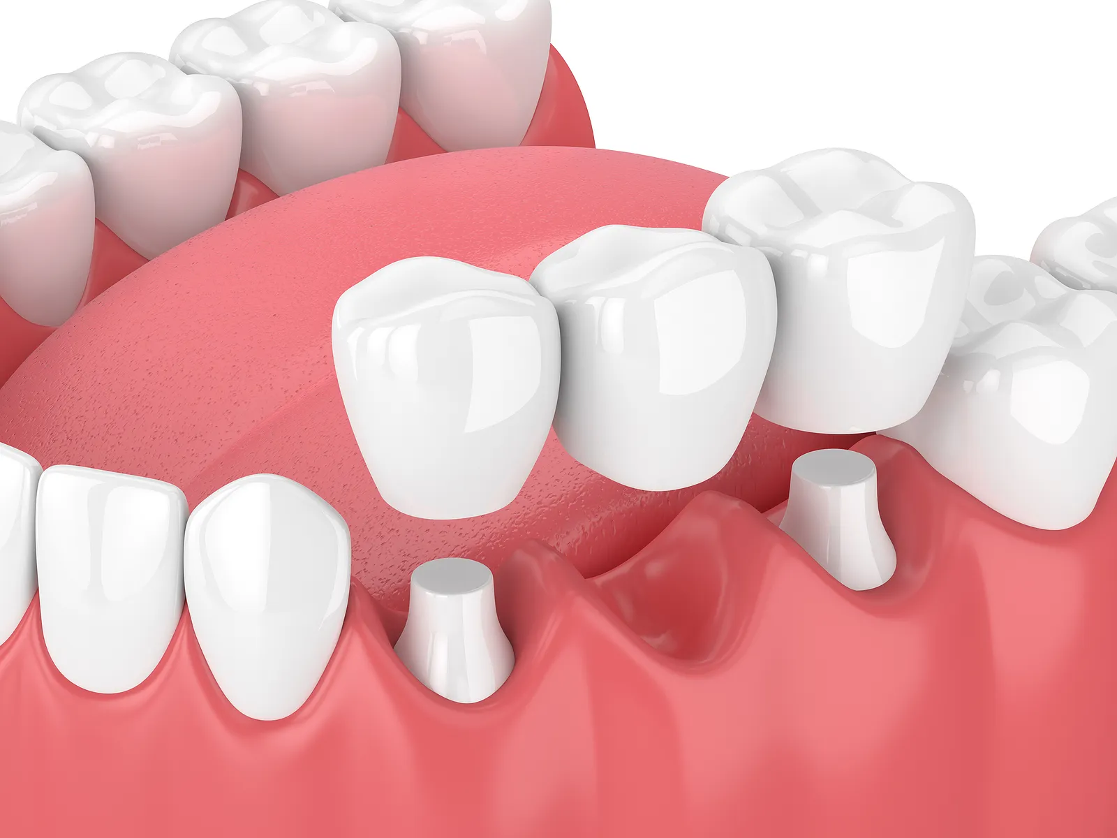 Dental Bridges: A Comprehensive Guide to Restoring Your Smile