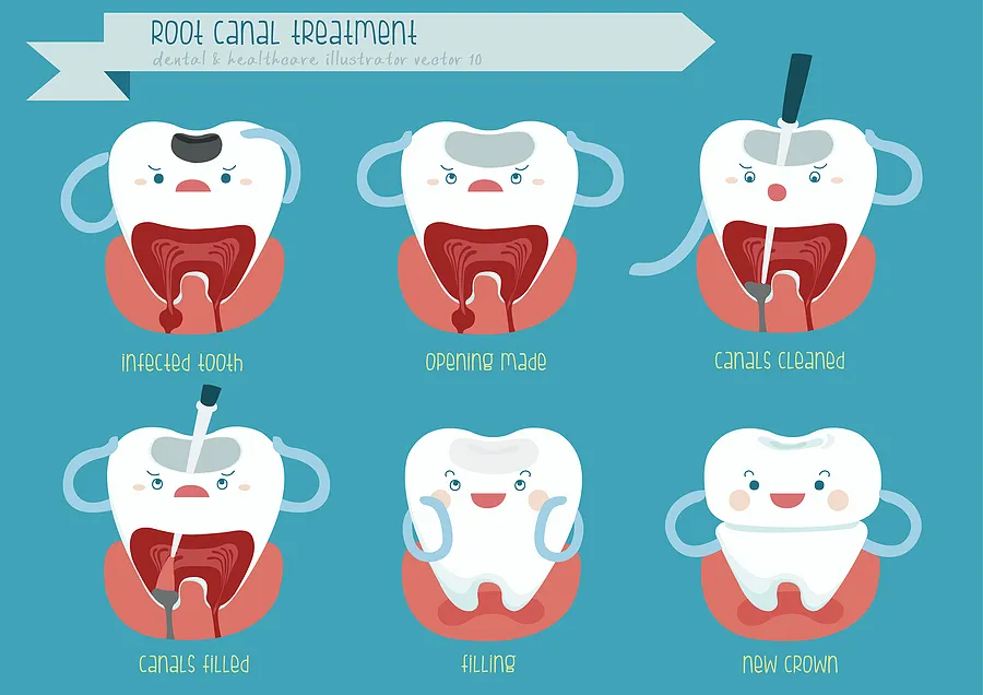Preserving Your Smile: Understanding Root Canal Therapy