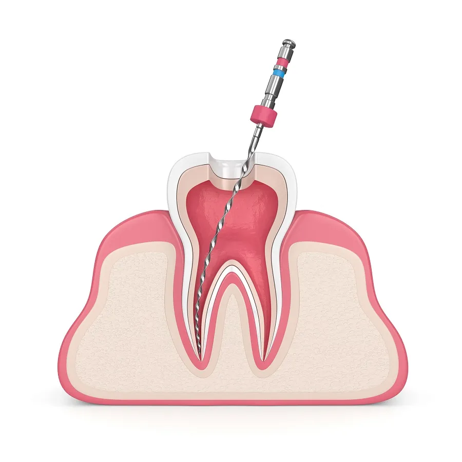 The Truth About Root Canals; Why They Aren’t So Bad